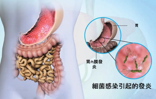 胃發炎可以喝什麼？營養師教你5大安心飲品與3大地雷清單