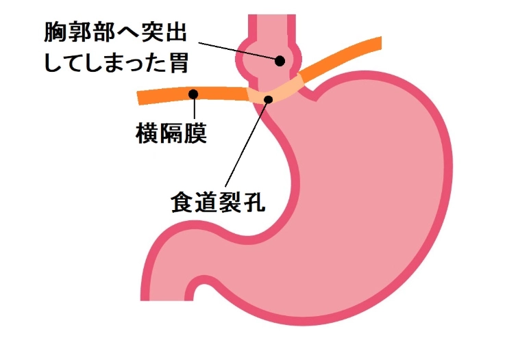 胃食道逆流食療