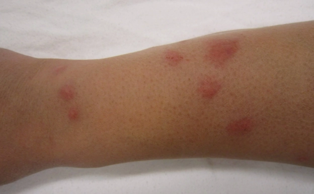 床蝨怎麼消滅？專家教你從檢查到根除的完整攻略