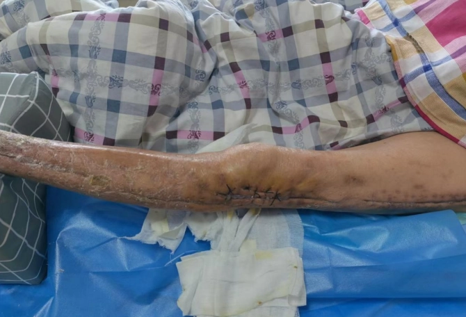 多囊性卵巢會自己好嗎？專家解析真相與改善策略