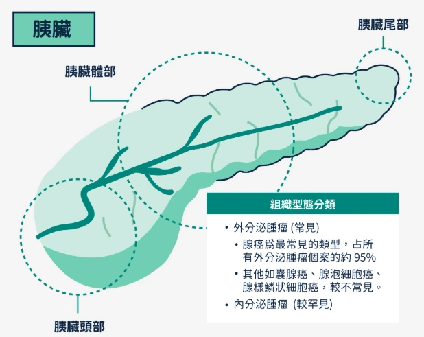 壞死性胰臟炎 症狀