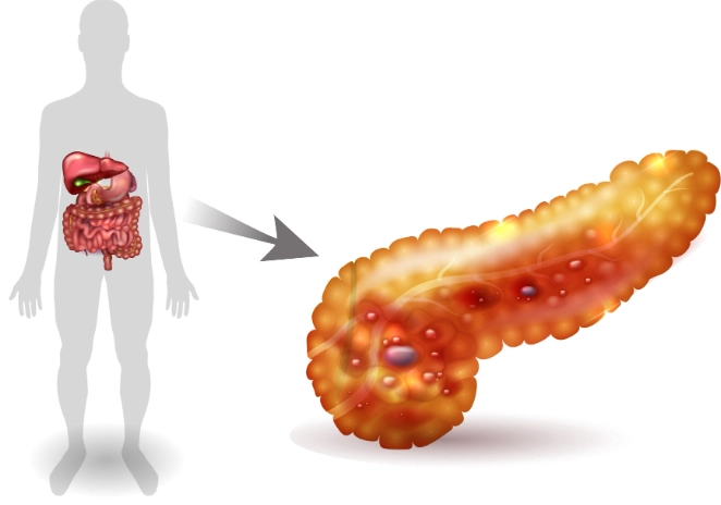 多囊性卵巢症候群治療
