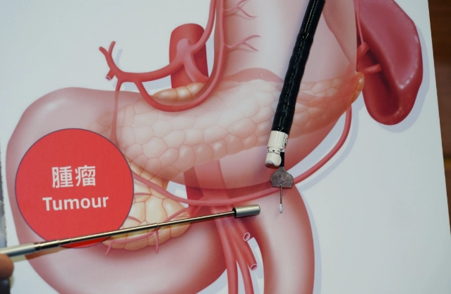 胃脹氣快速解決