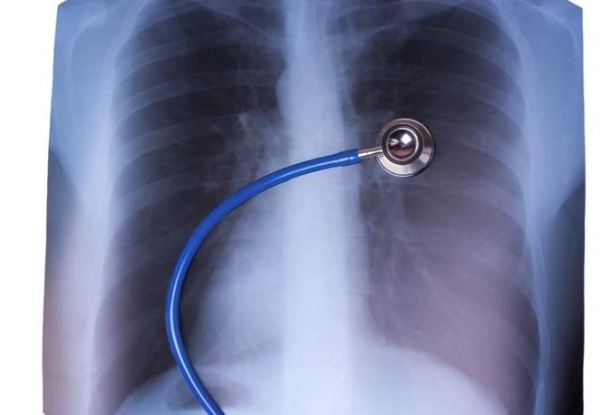 支氣管擴張症狀