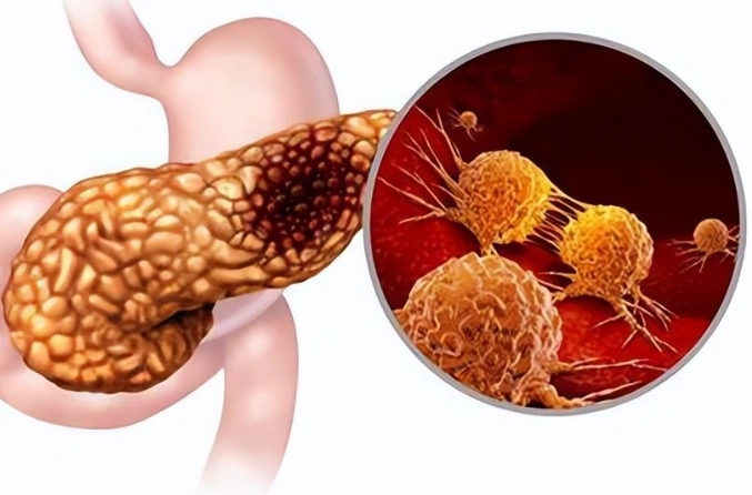 胰臟炎飲食指南