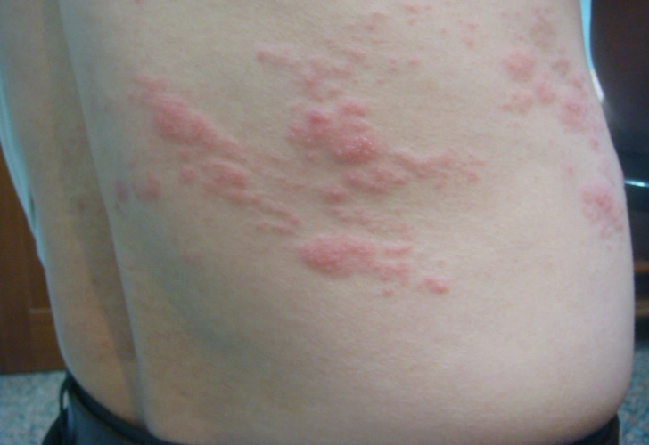 帶狀皰疹海鮮禁忌