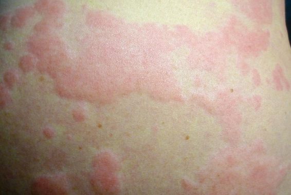 吃完東西全身癢？食物過敏症狀、原因與解決方案全解析