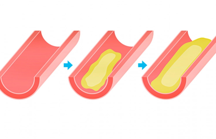 運動 逆轉 血管鈣化