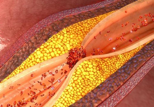 運動 逆轉 血管鈣化