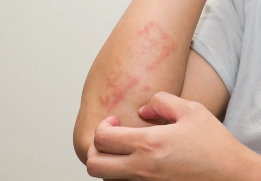 皮膚敏感飲食禁忌指南：這些食物請避開，告別紅腫癢！