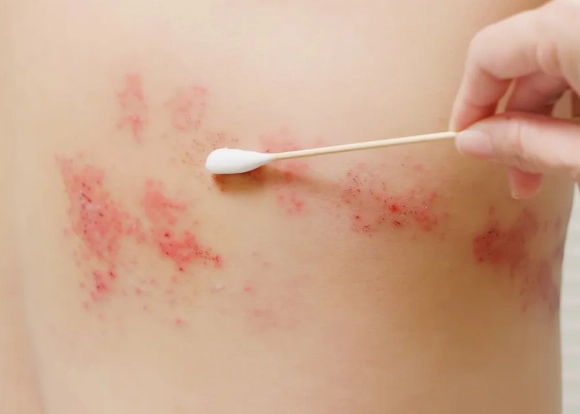 帶狀皰疹海鮮禁忌