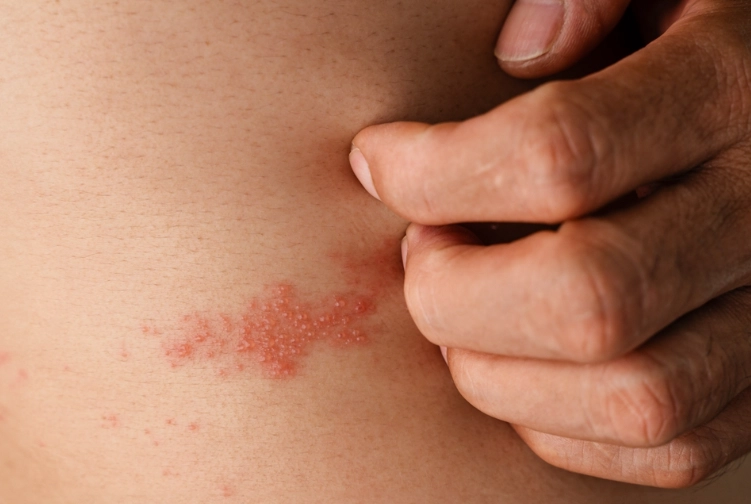 雞肉對帶狀皰疹