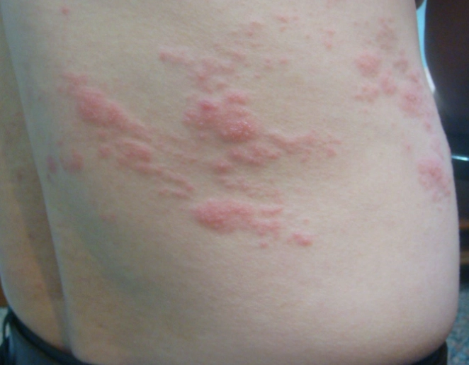 帶狀皰疹可以喝茶嗎？醫師與營養師的完整解析與建議