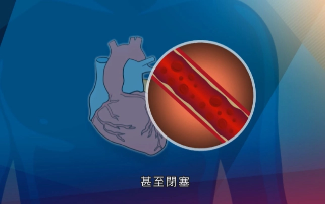 血管鈣化如何改善