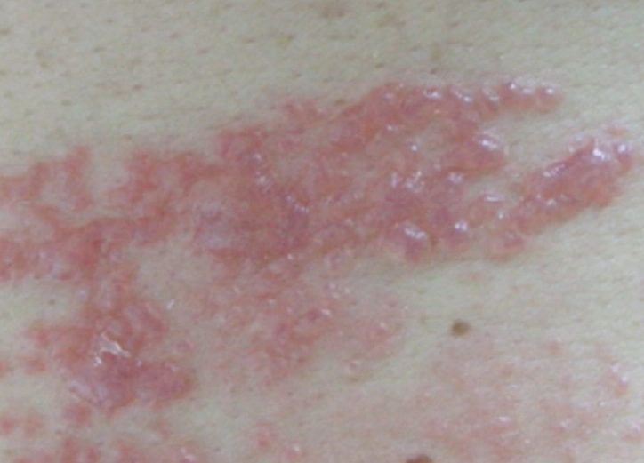 帶狀皰疹可以吃雞肉嗎？醫師完整解析飲食禁忌與建議