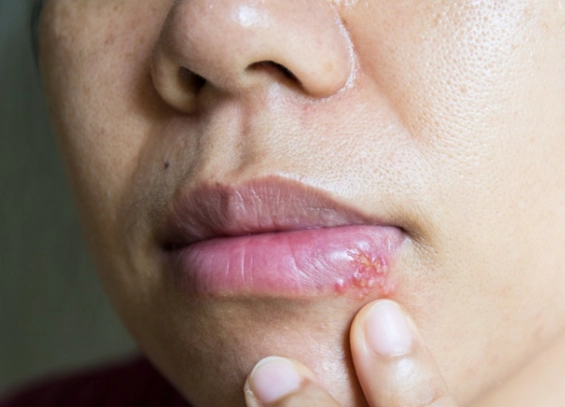 小孩唇皰疹症狀與治療全攻略：家長必讀實用指南