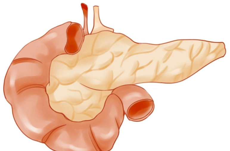 急性胰臟炎死亡率全解析：關鍵風險、治療與預防策略