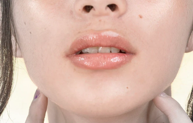 嬰兒唇皰疹