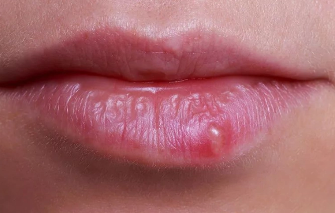 唇皰疹治療