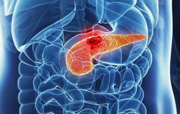 膽囊炎 胰臟炎 飲食