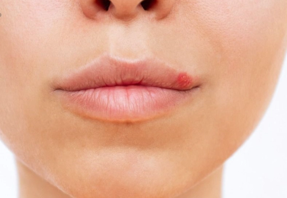 唇皰疹結痂還需要擦藥嗎？皮膚科醫師詳解照護關鍵