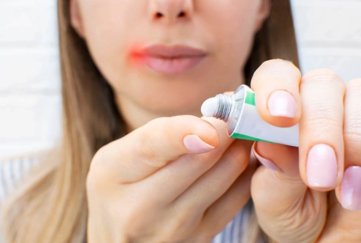 唇皰疹結痂擦藥