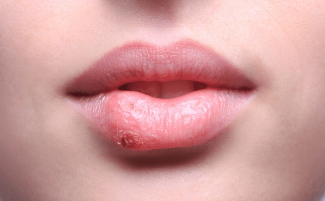 唇皰疹初期圖片