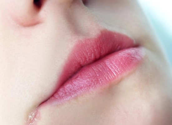 唇皰疹初期圖片