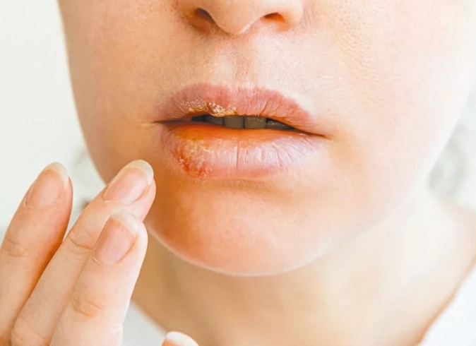 唇皰疹初期圖片