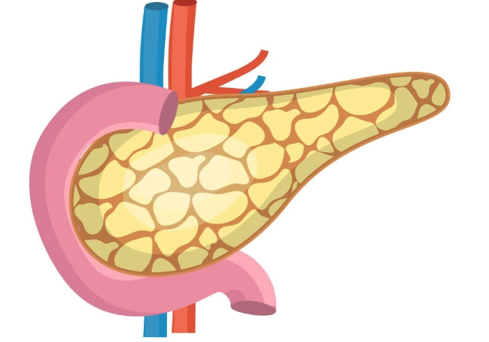 胰臟炎 高血糖 飲食