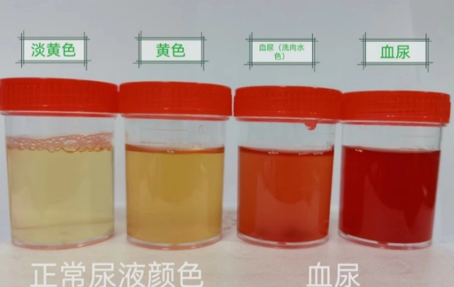 一直喝水沒尿意