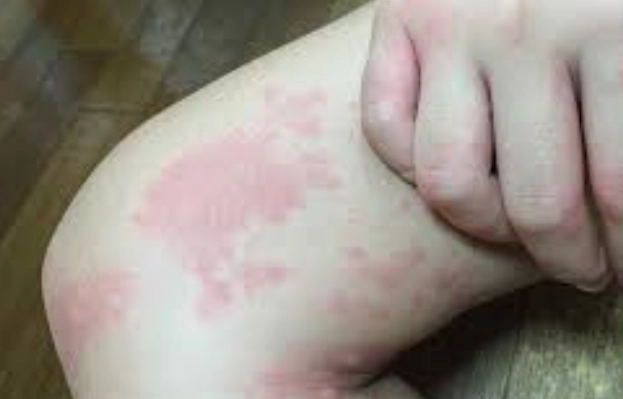 紅麴過敏怎麼辦