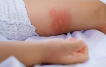 蕁麻疹 可以吃什麼