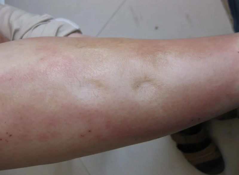中醫消水腫 中醫消水腫