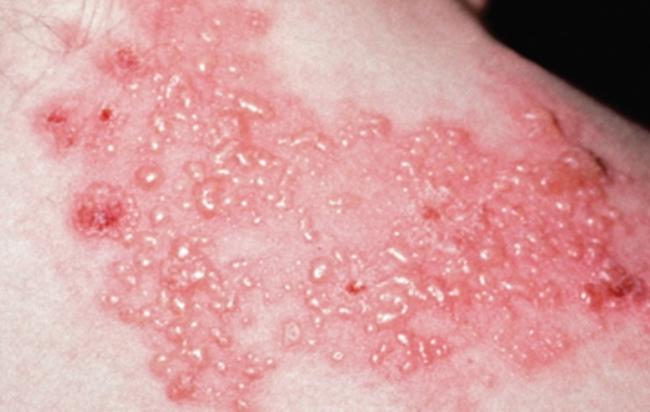 泡狀病毒症狀
