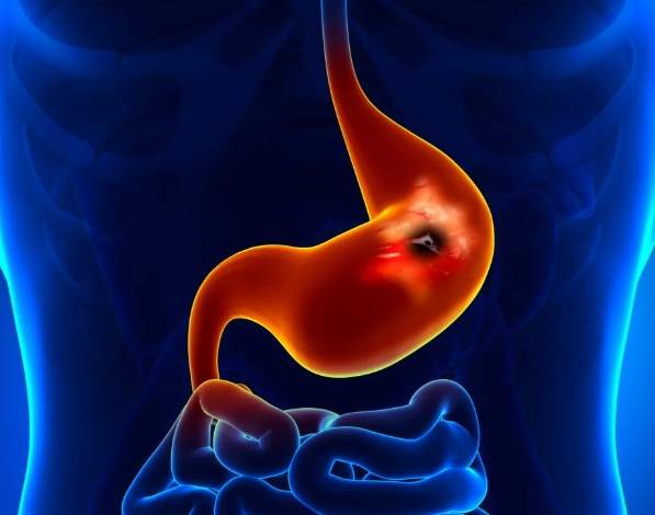 胃潰瘍飲食
