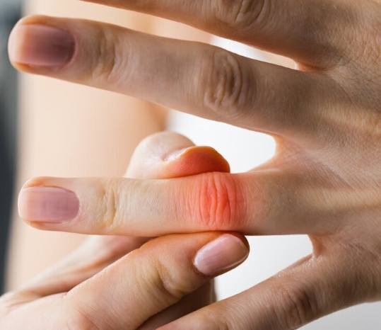 關節炎飲食建議