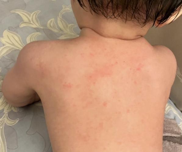 皮膚過敏食物清單