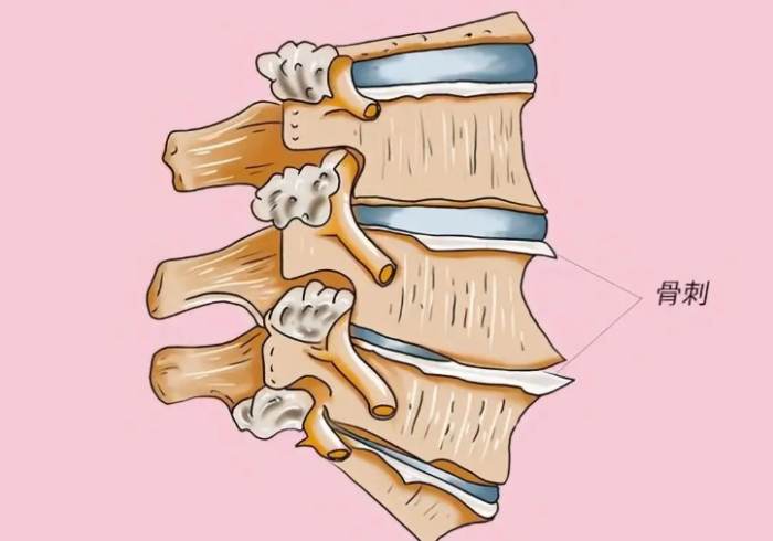 長骨刺飲食禁忌