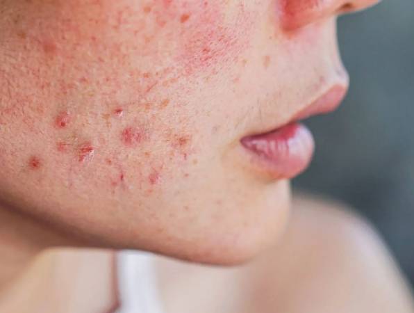 過敏不能吃的水果