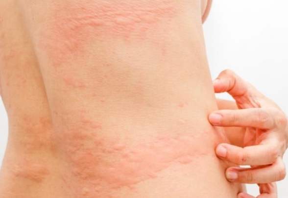 皮膚過敏水果禁忌