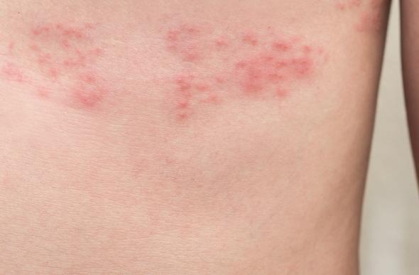 帶狀皰疹可以吃什麼