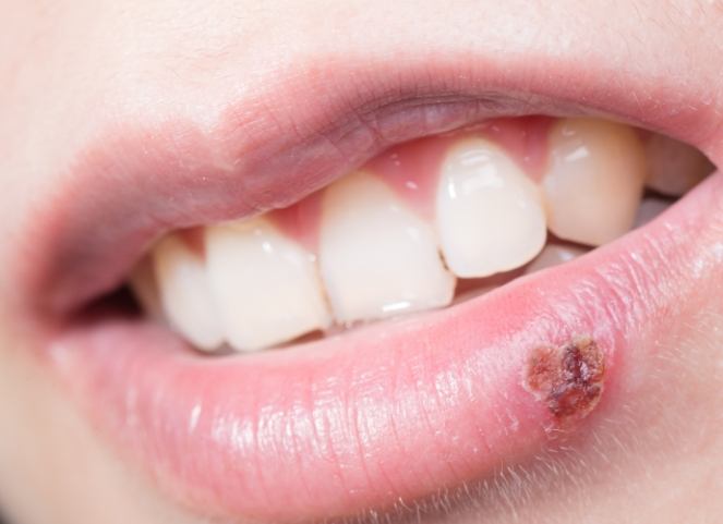 唇皰疹結痂期症狀