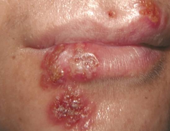 唇皰疹結痂期症狀