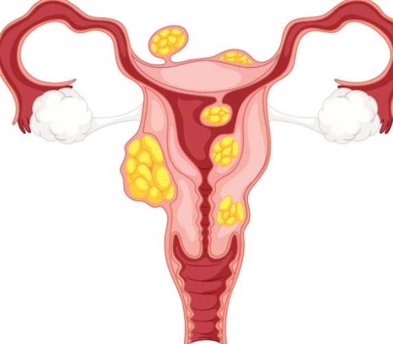 燕窝对子宫肌瘤影响