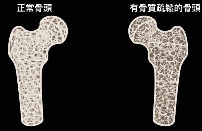 骨質疏鬆預防