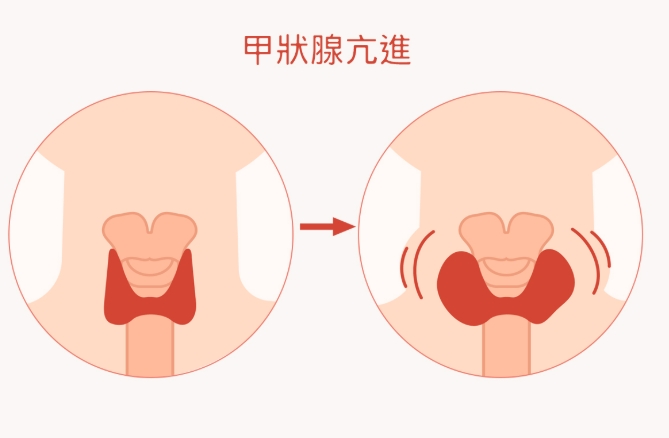 甲狀腺亢進飲食禁忌