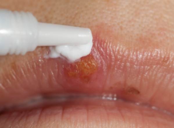 唇皰疹結痂護理