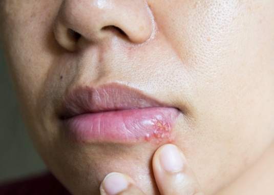 唇疱疹治療
