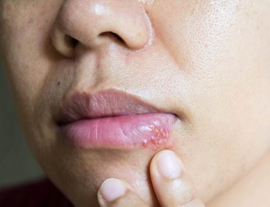 唇邊水泡治療